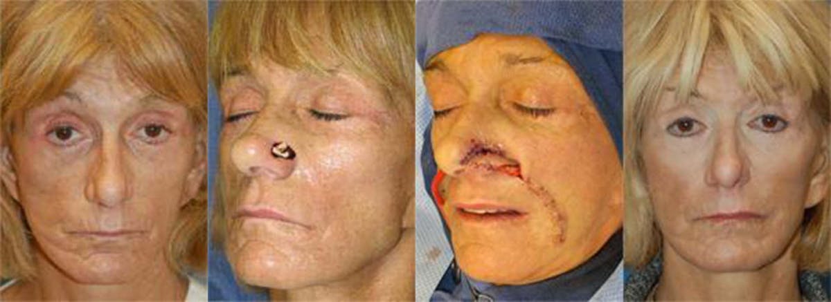 Mohs Surgery and Skin Cancer Before & After Gallery - Patient 122406381 - Image 1