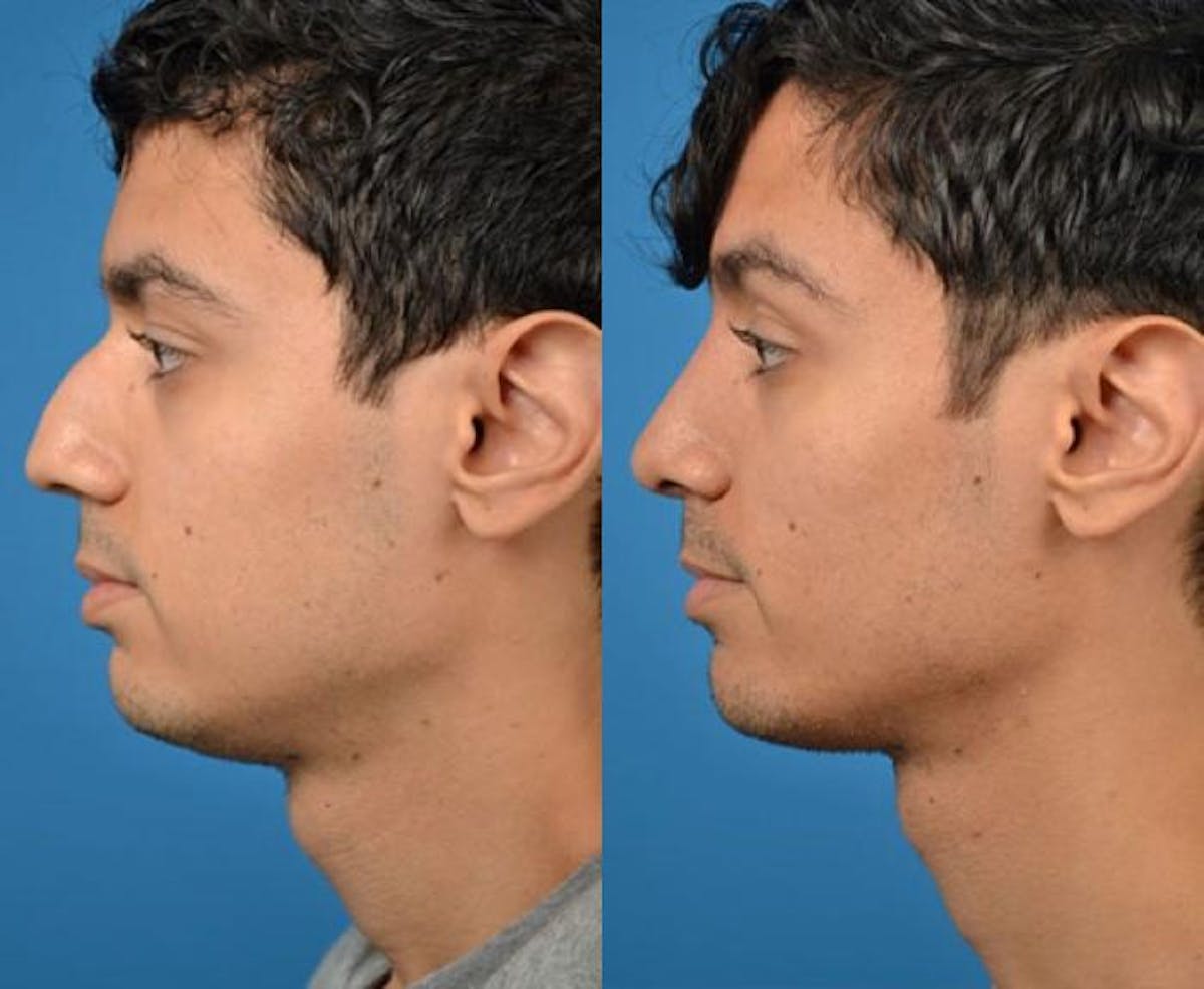 Male Rhinoplasty Before & After Gallery - Patient 122406384 - Image 2