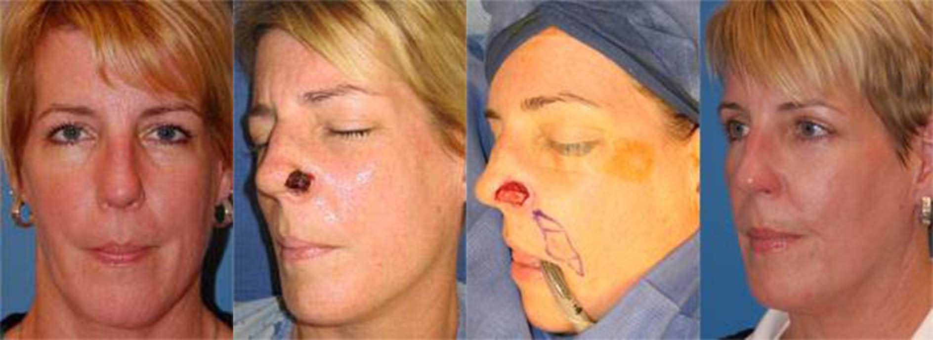 Mohs Surgery and Skin Cancer Before & After Gallery - Patient 122406383 - Image 1