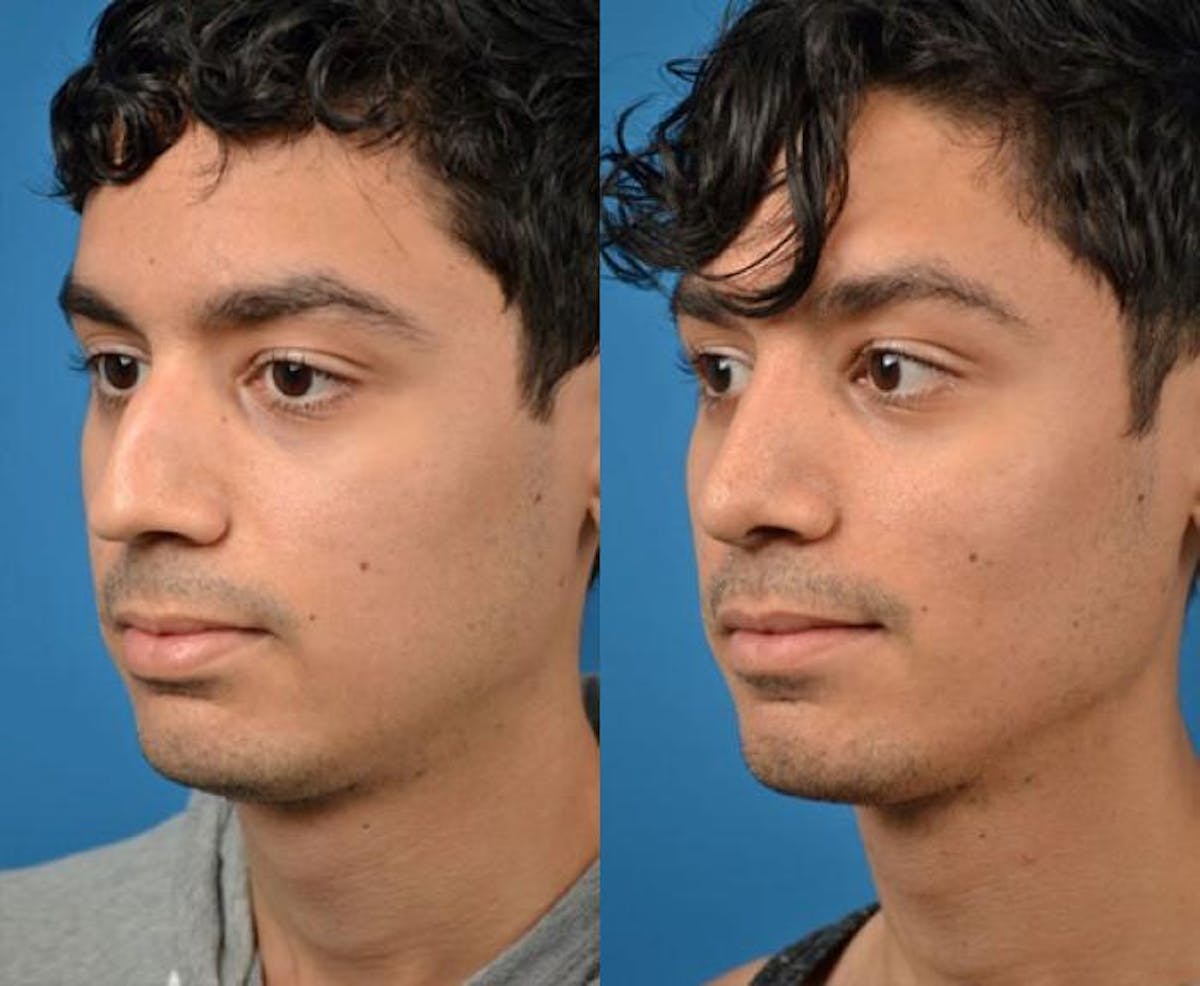 Rhinoplasty Before & After Gallery - Patient 142762988 - Image 3