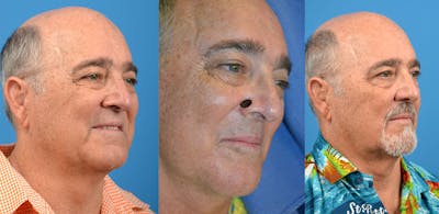 Mohs Surgery and Skin Cancer Before & After Gallery - Patient 122406385 - Image 1