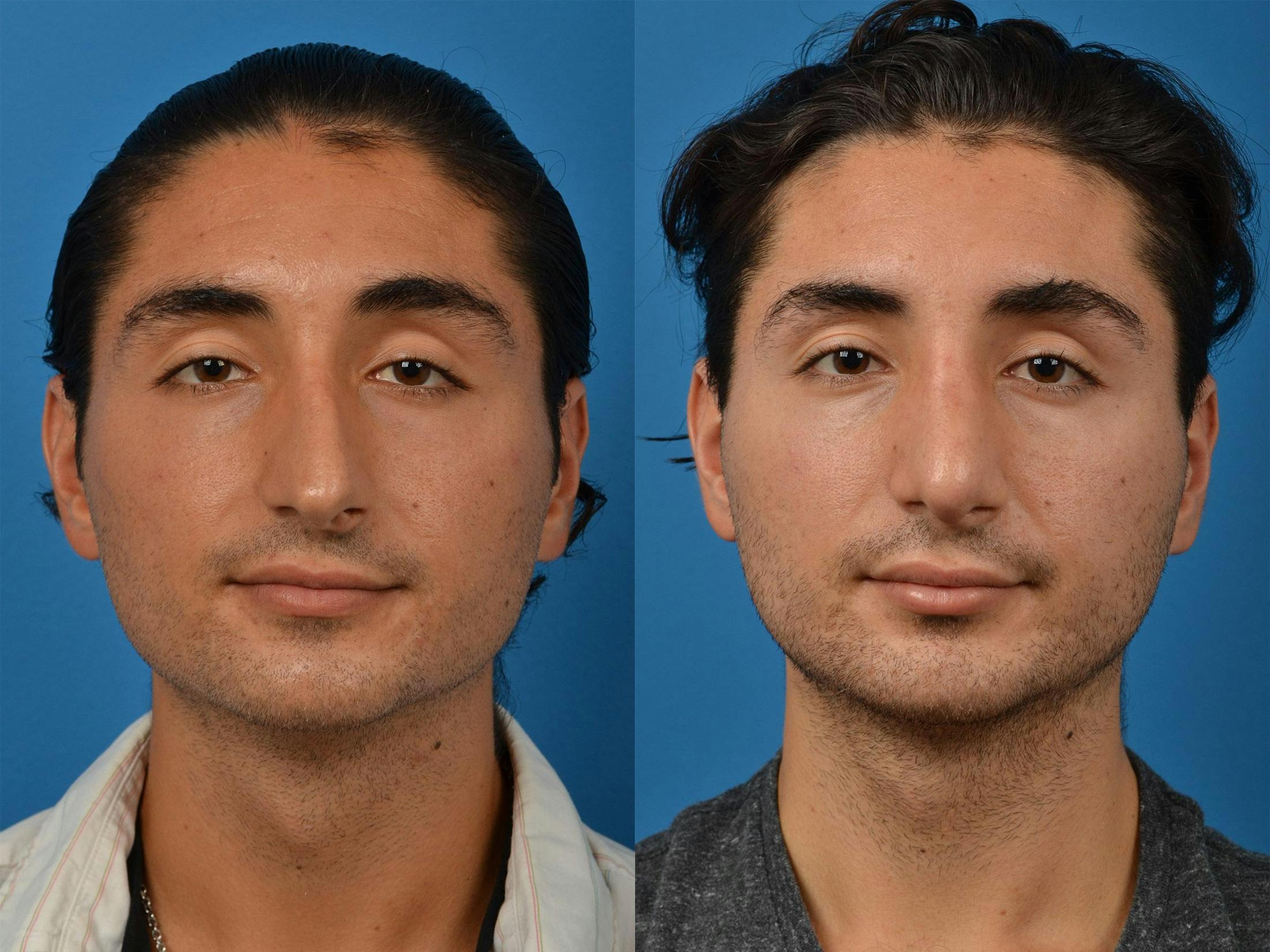 Male Rhinoplasty Before & After Gallery - Patient 122406391 - Image 1