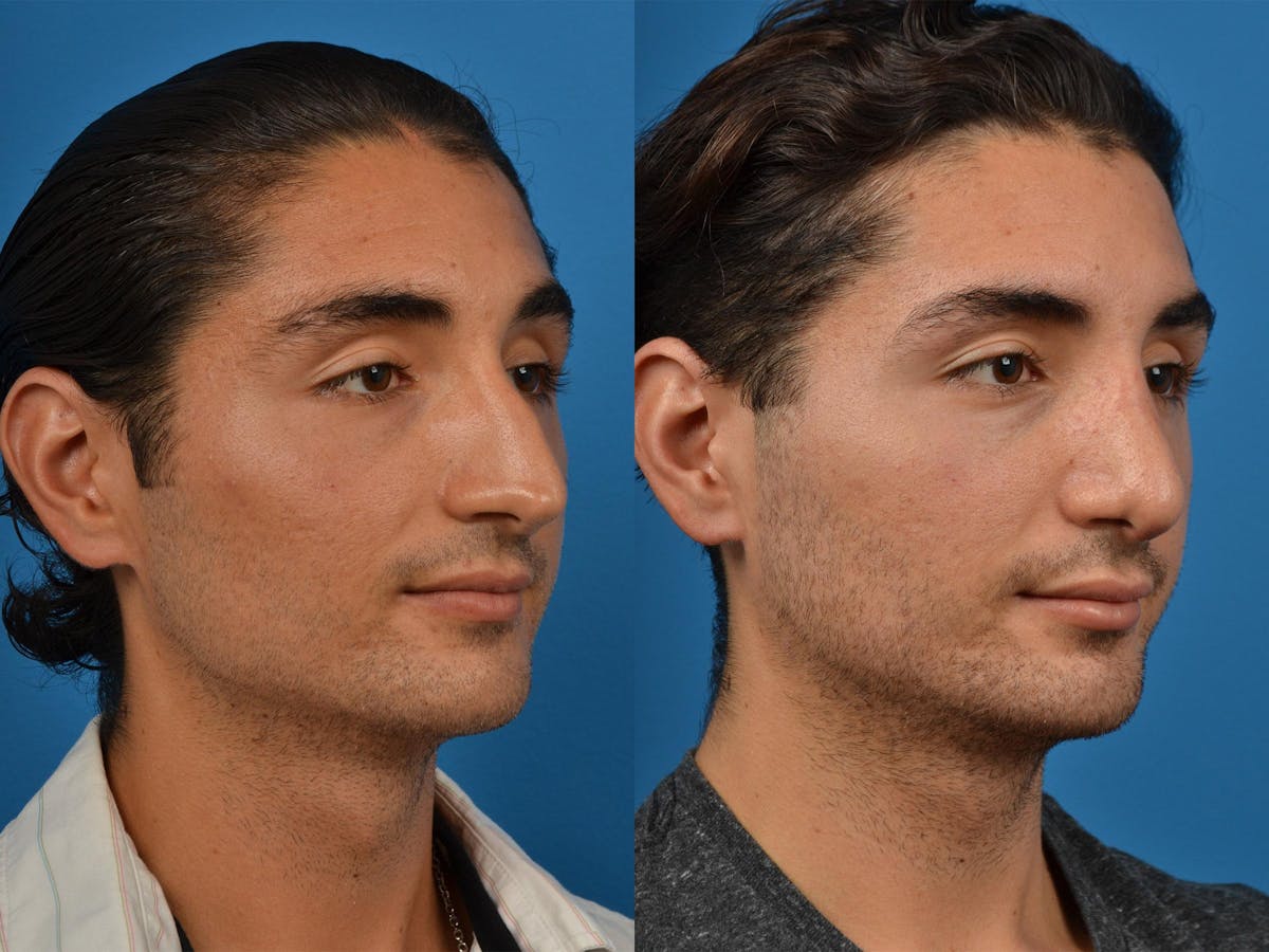 Rhinoplasty Before & After Gallery - Patient 142762989 - Image 2