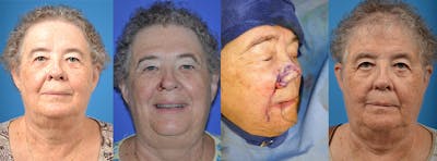 Mohs Surgery and Skin Cancer Before & After Gallery - Patient 122406386 - Image 1
