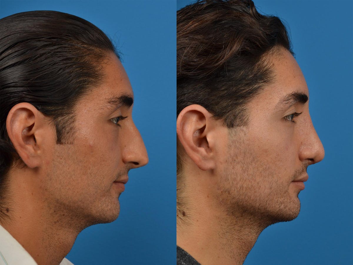 Male Rhinoplasty Before & After Gallery - Patient 122406391 - Image 3