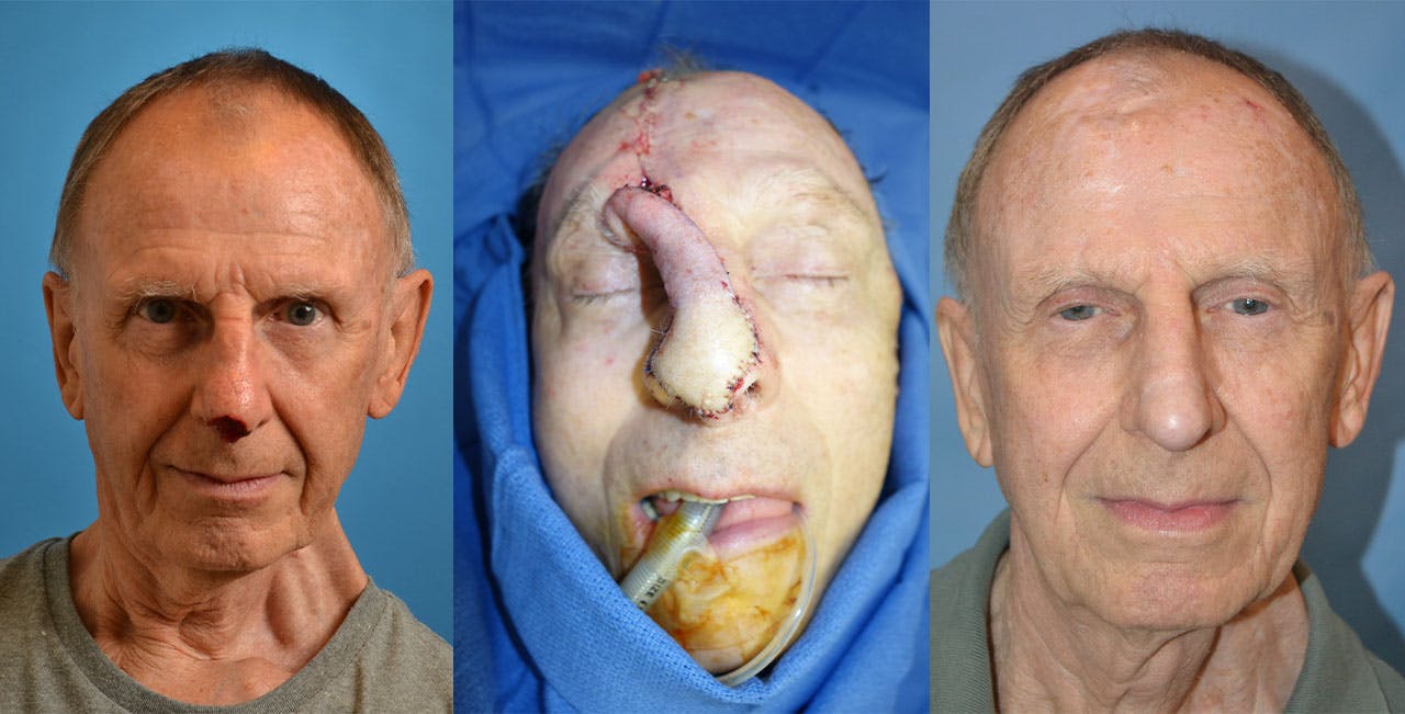 Mohs Surgery and Skin Cancer Before & After Gallery - Patient 122406387 - Image 1