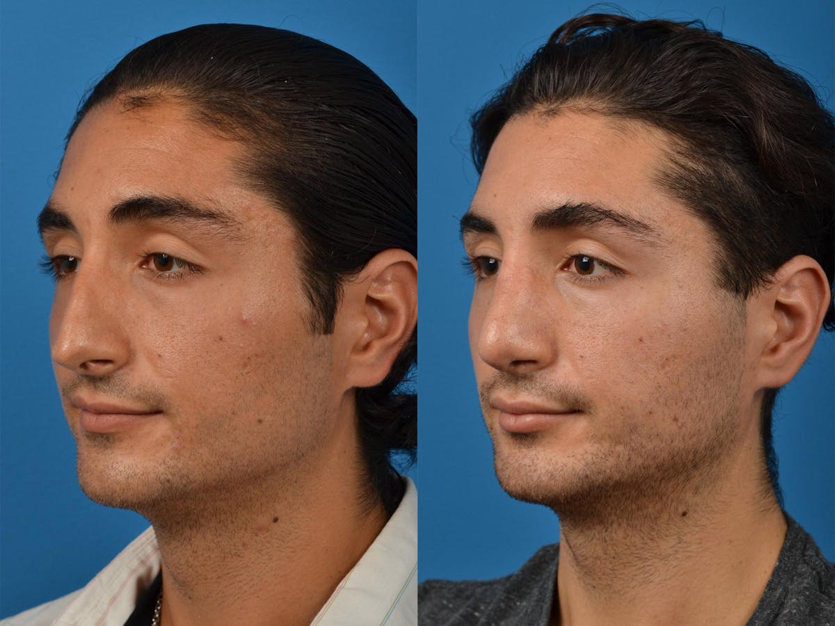 Male Rhinoplasty Before & After Gallery - Patient 122406391 - Image 4