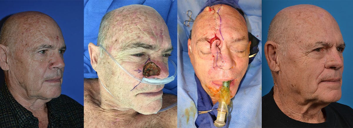 Mohs Surgery and Skin Cancer Before & After Gallery - Patient 122406388 - Image 1