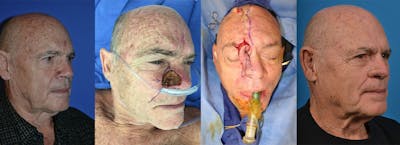 Mohs Surgery and Skin Cancer Before & After Gallery - Patient 122406388 - Image 1