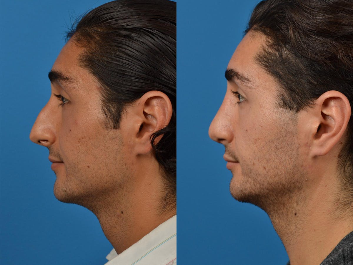 Rhinoplasty Before & After Gallery - Patient 142762989 - Image 5