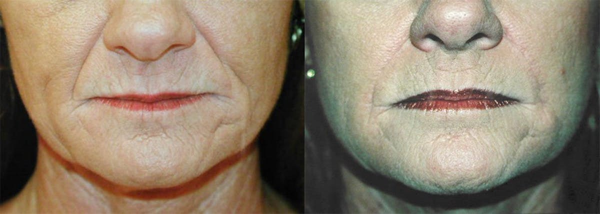 Nasolabial Folds Before & After Gallery - Patient 122406389 - Image 1