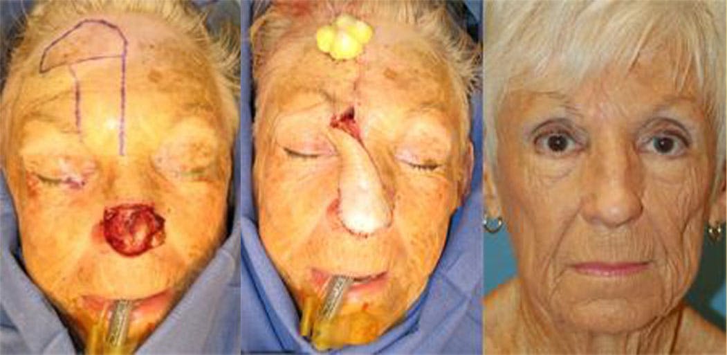 Mohs Surgery and Skin Cancer Gallery - Patient 122406390 - Image 1