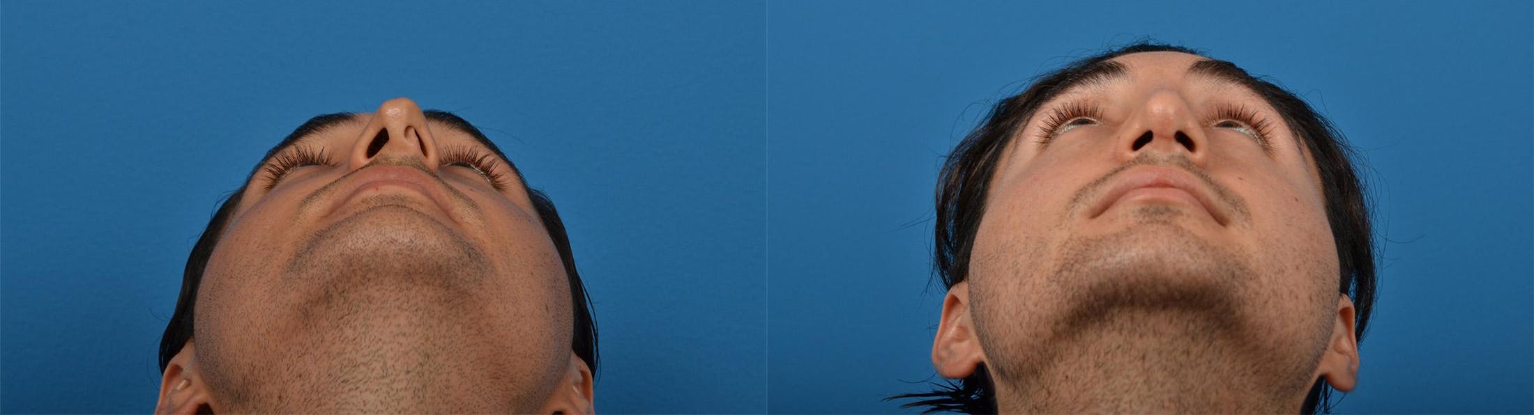 Rhinoplasty Before & After Gallery - Patient 142762989 - Image 6