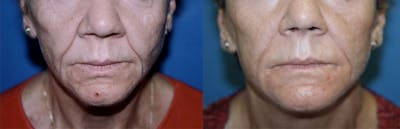 Nasolabial Folds Before & After Gallery - Patient 122406392 - Image 1
