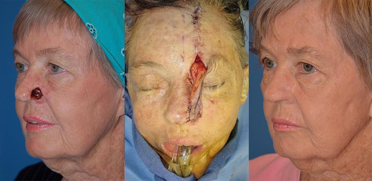 Mohs Surgery and Skin Cancer Before & After Gallery - Patient 122406393 - Image 1