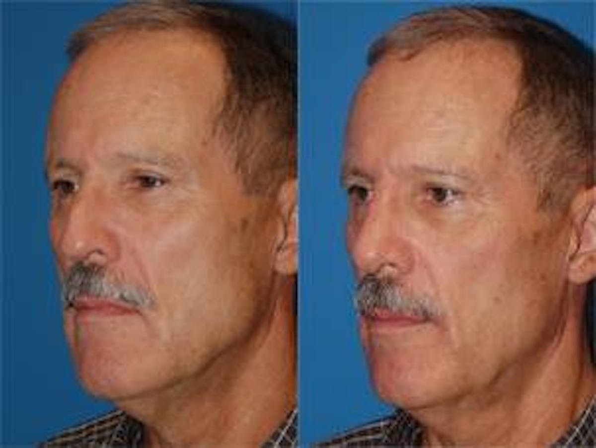 Male Rhinoplasty Before & After Gallery - Patient 122406395 - Image 1