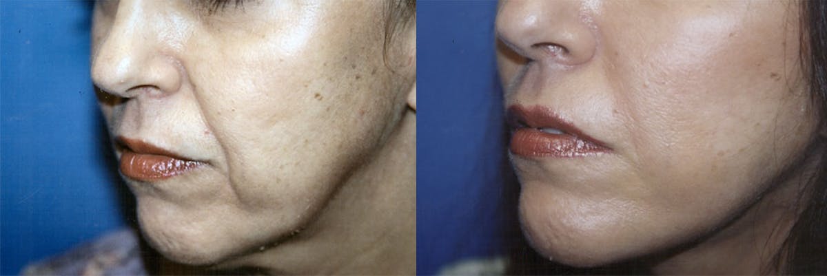 Nasolabial Folds Before & After Gallery - Patient 122406394 - Image 1