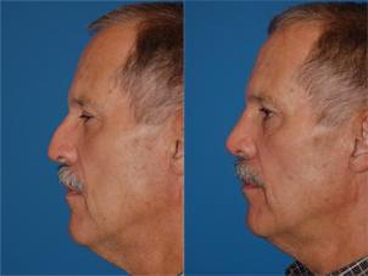 Rhinoplasty Before & After Gallery - Patient 142762990 - Image 2