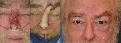 Mohs Surgery and Skin Cancer Before & After Gallery - Patient 122406396 - Image 1