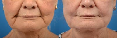 Nasolabial Folds Before & After Gallery - Patient 122406399 - Image 1