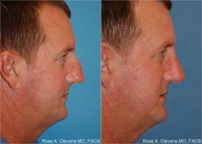Male Rhinoplasty Before & After Gallery - Patient 122406397 - Image 1
