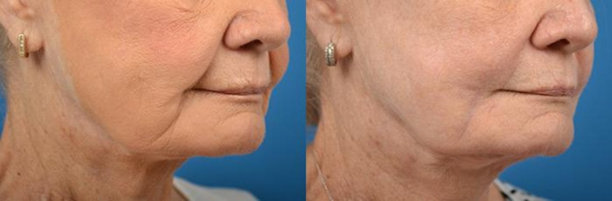Nasolabial Folds Before & After Gallery - Patient 122406399 - Image 2