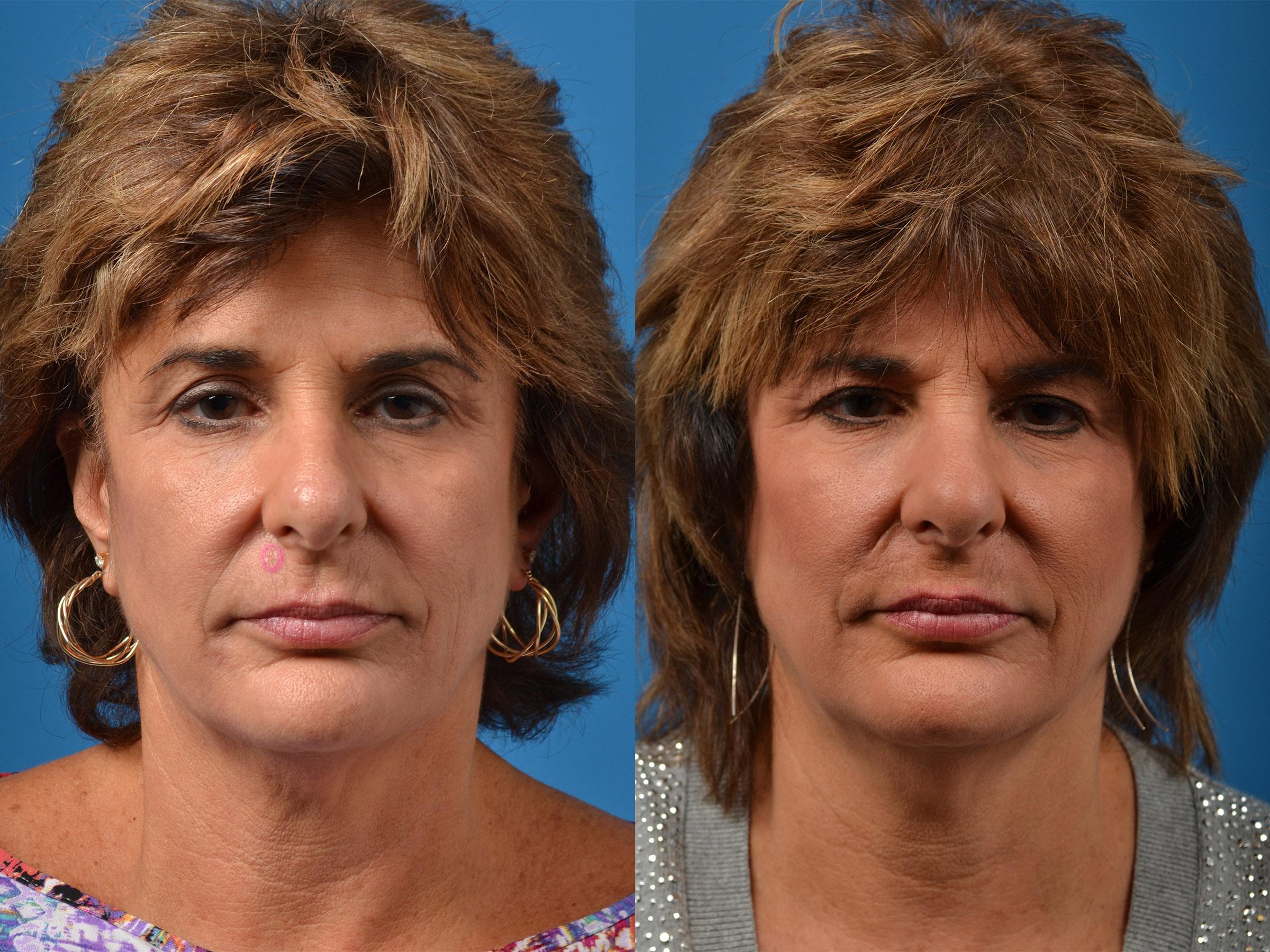 Mohs Surgery and Skin Cancer Before & After Gallery - Patient 122406411 - Image 1