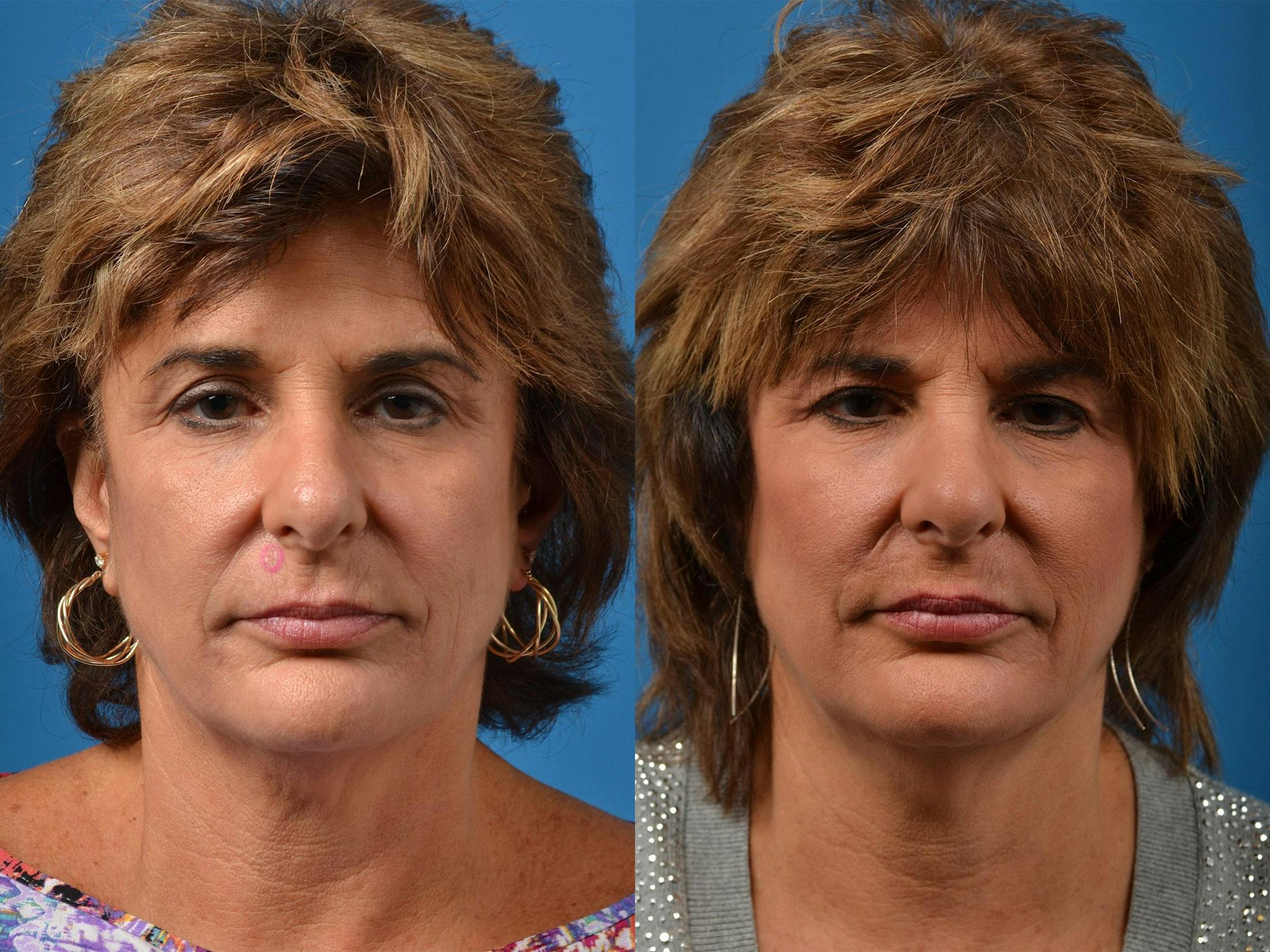Mohs Surgery and Skin Cancer Before & After Gallery - Patient 122406411 - Image 1