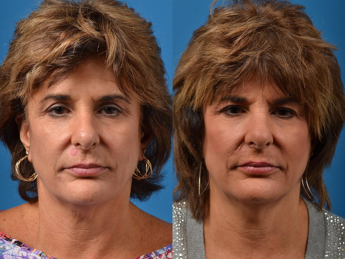 Mohs Surgery and Skin Cancer Before & After Gallery - Patient 122406411 - Image 1