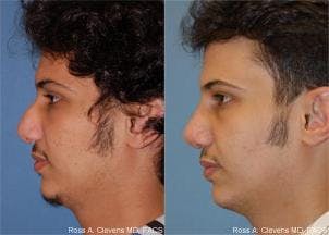 Male Rhinoplasty Before & After Gallery - Patient 122406398 - Image 1