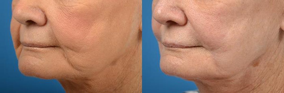 Nasolabial Folds Before & After Gallery - Patient 122406399 - Image 3