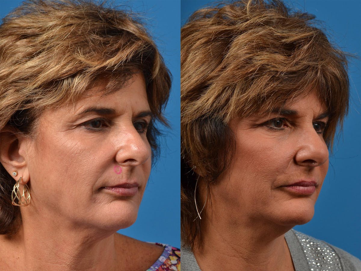 Mohs Surgery and Skin Cancer Before & After Gallery - Patient 122406411 - Image 2