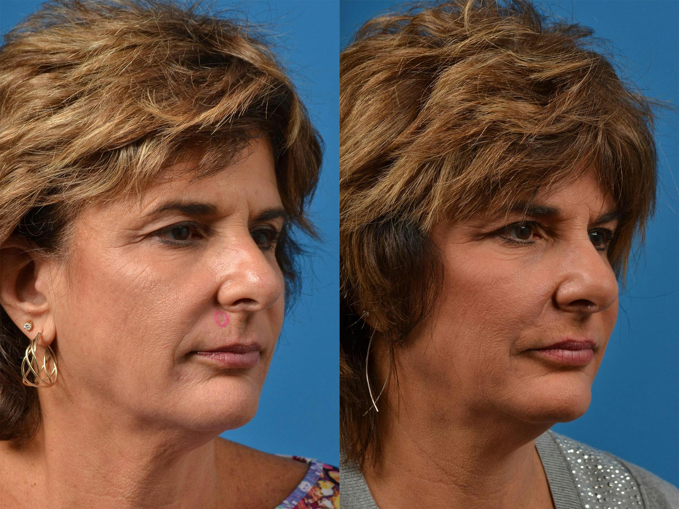 Mohs Surgery and Skin Cancer Before & After Gallery - Patient 122406411 - Image 2