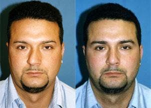 Male Rhinoplasty Before & After Gallery - Patient 122406405 - Image 1
