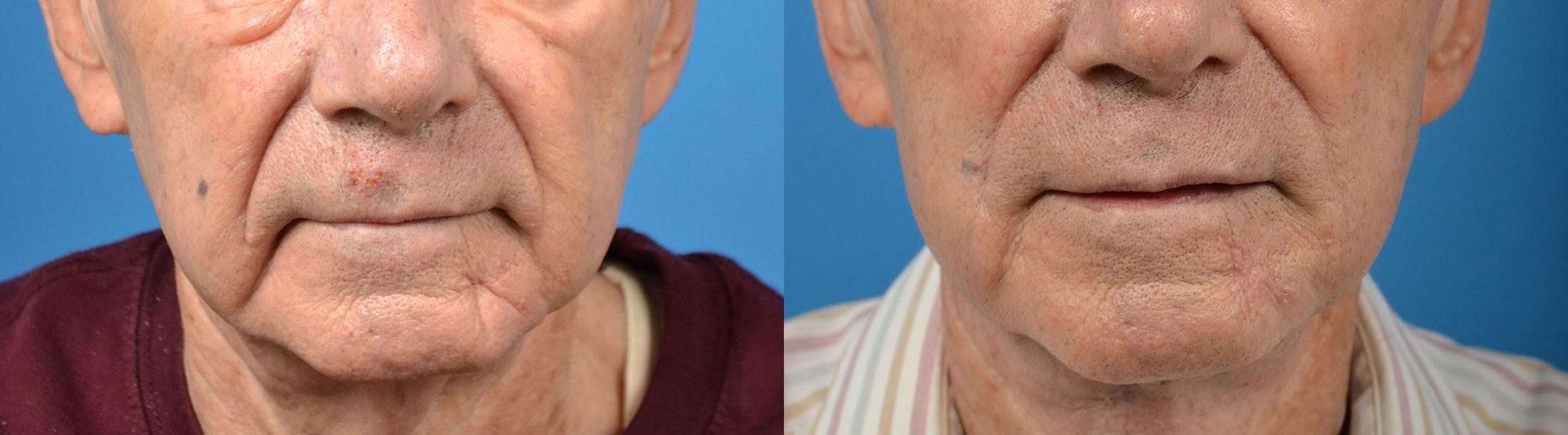 Nasolabial Folds Before & After Gallery - Patient 122406408 - Image 1