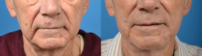 Nasolabial Folds Before & After Gallery - Patient 122406408 - Image 1