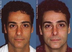 Rhinoplasty Before & After Gallery - Patient 142762994 - Image 1