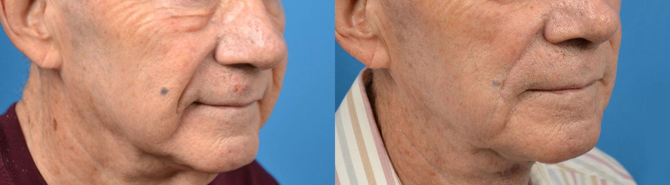 Nasolabial Folds Before & After Gallery - Patient 122406408 - Image 2
