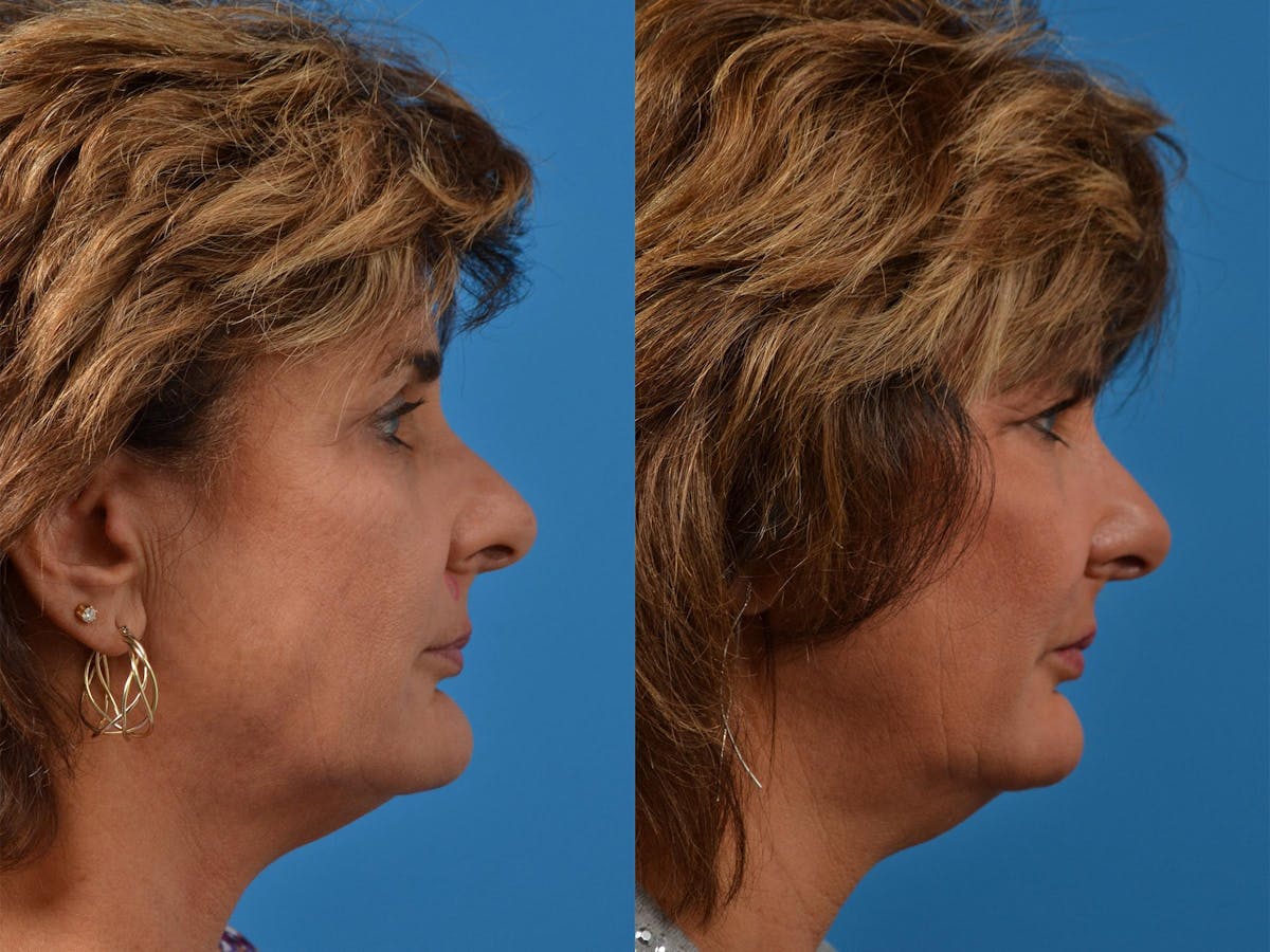Mohs Surgery and Skin Cancer Before & After Gallery - Patient 122406411 - Image 3