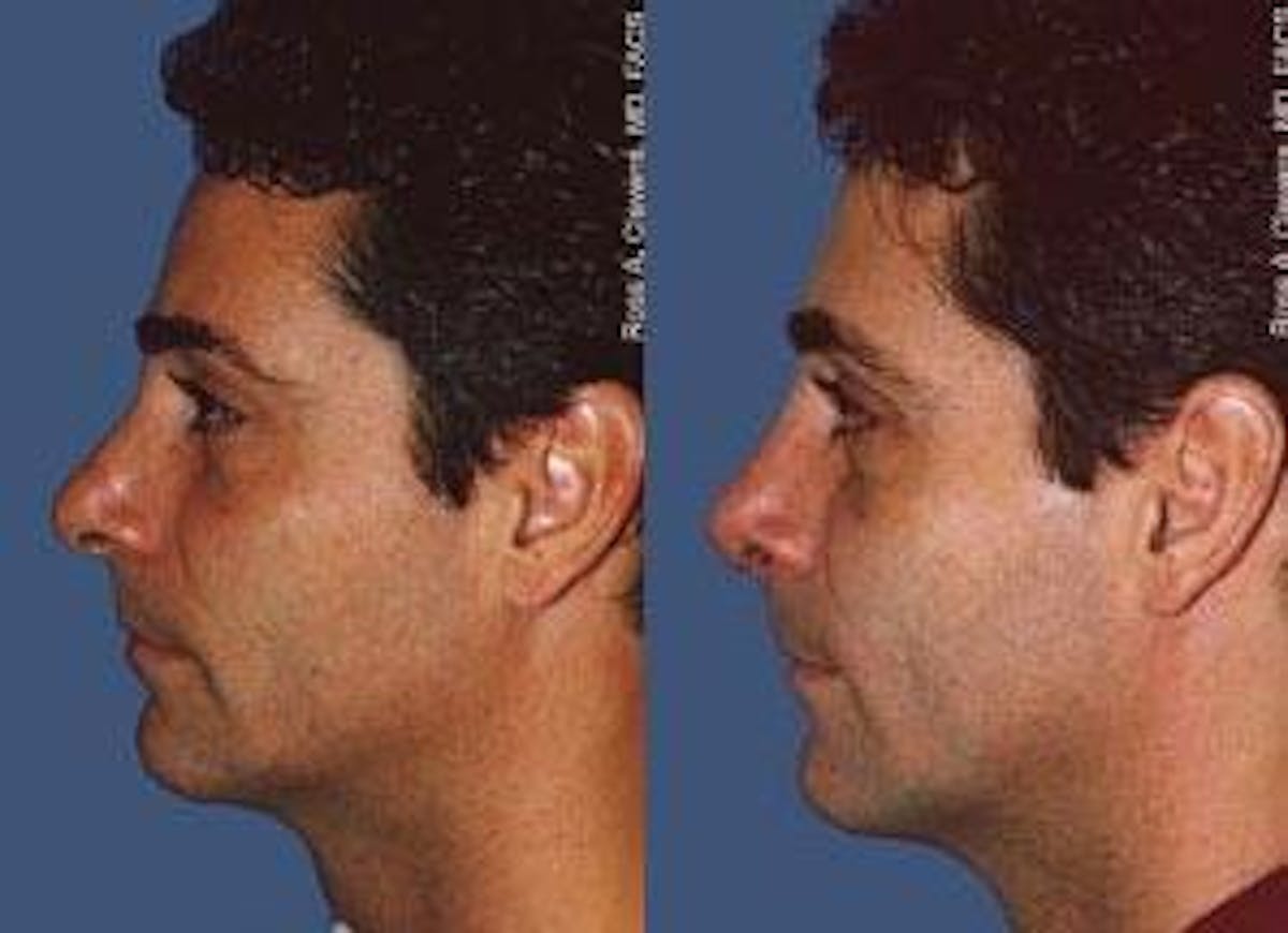 Rhinoplasty Before & After Gallery - Patient 142762994 - Image 2