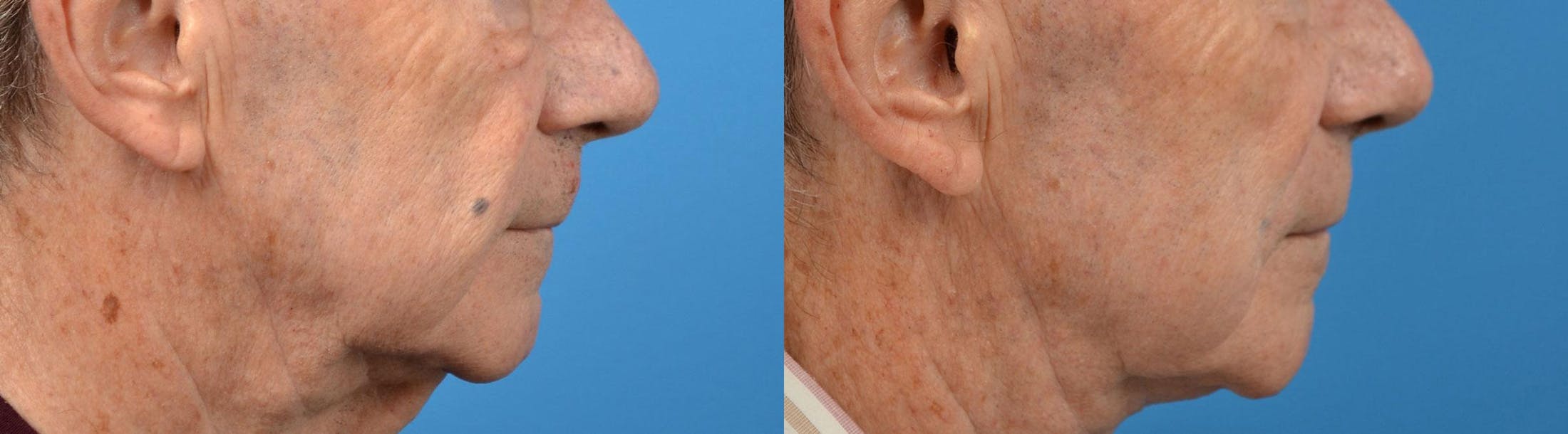 Nasolabial Folds Before & After Gallery - Patient 122406408 - Image 3
