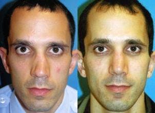 Rhinoplasty Before & After Gallery - Patient 142762996 - Image 1