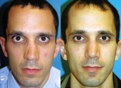 Male Rhinoplasty Before & After Gallery - Patient 122406407 - Image 1