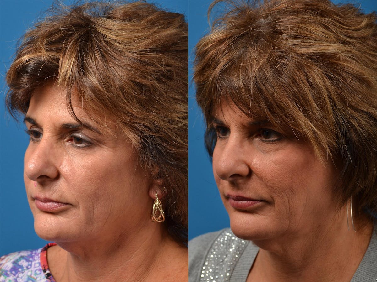 Mohs Surgery and Skin Cancer Before & After Gallery - Patient 122406411 - Image 4
