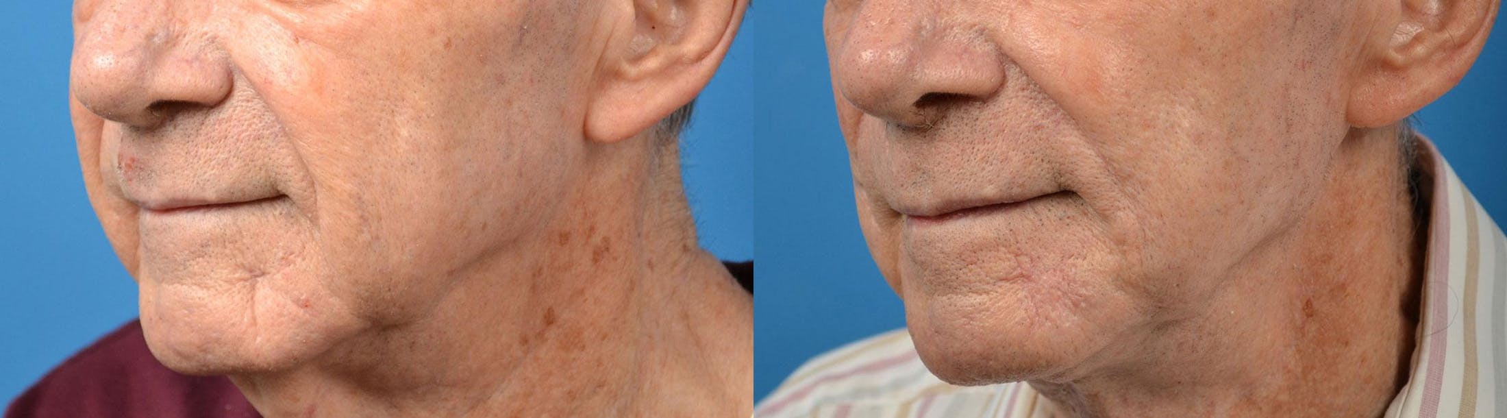 Nasolabial Folds Before & After Gallery - Patient 122406408 - Image 4