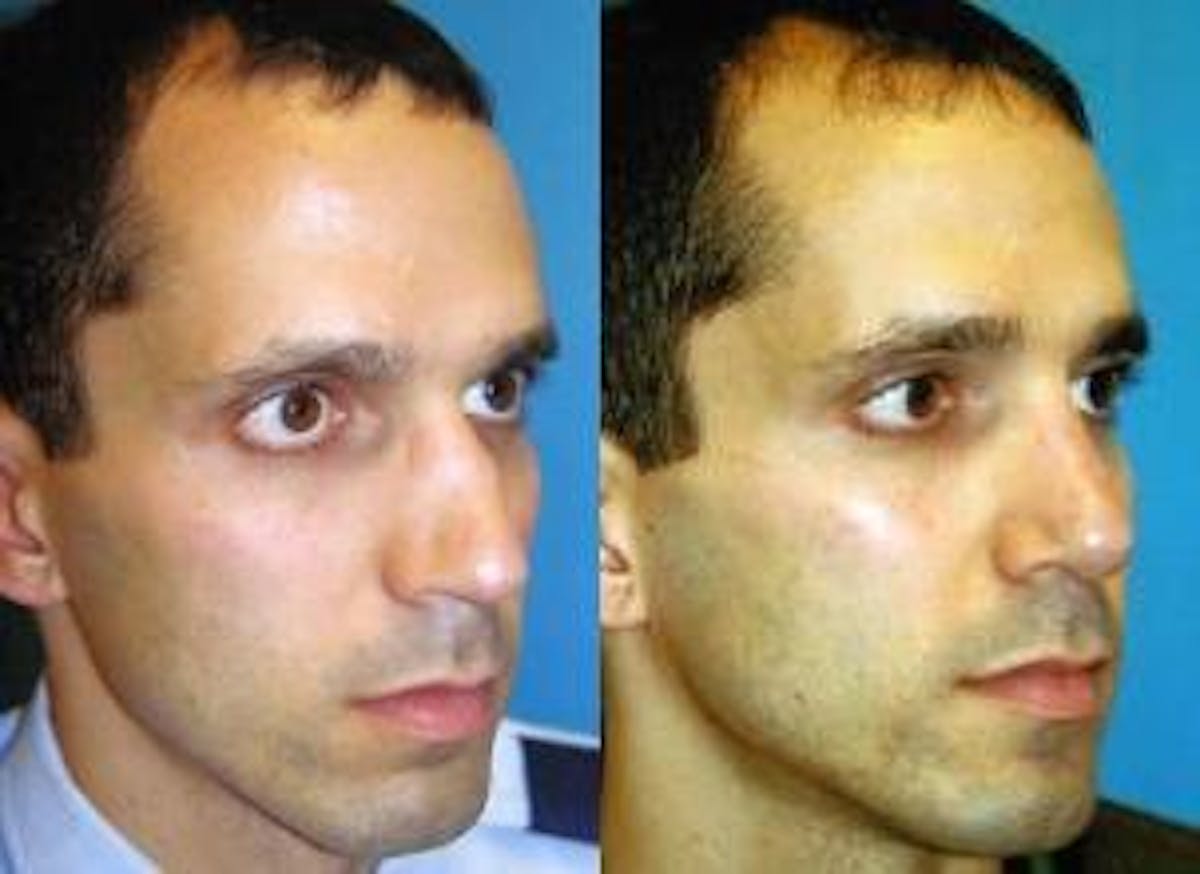 Rhinoplasty Before & After Gallery - Patient 142762996 - Image 2