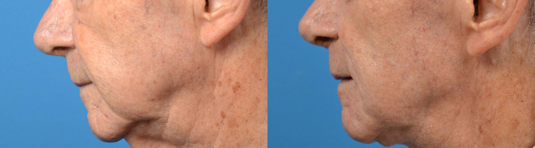 Nasolabial Folds Before & After Gallery - Patient 122406408 - Image 5