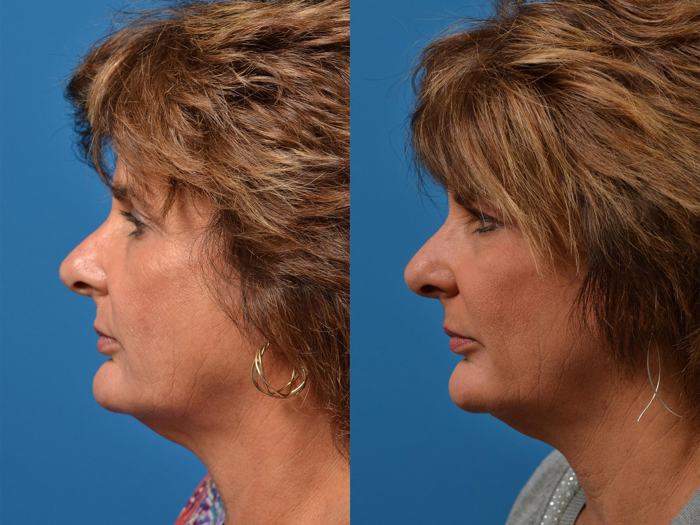Mohs Surgery and Skin Cancer Before & After Gallery - Patient 122406411 - Image 5