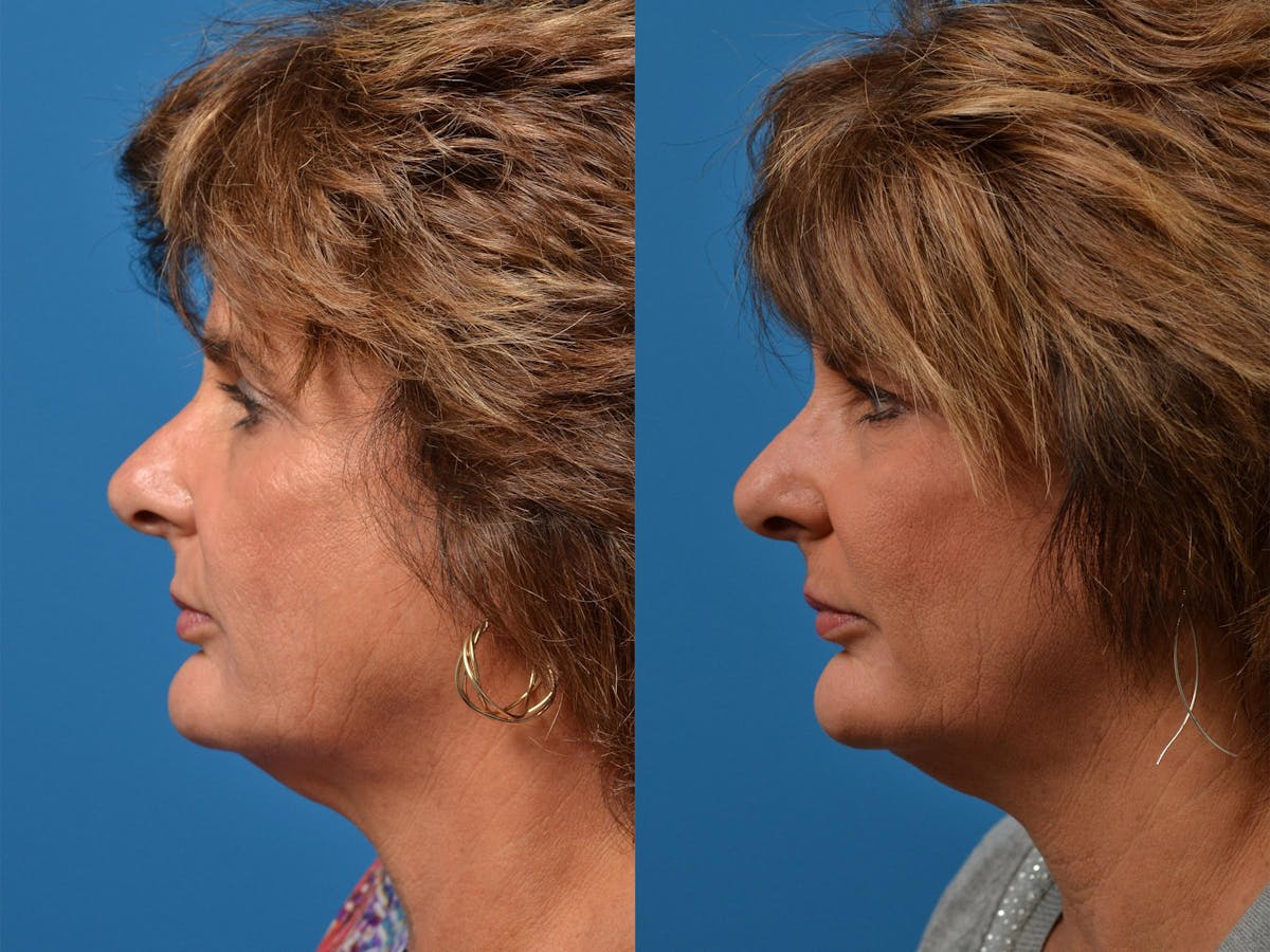 Mohs Surgery and Skin Cancer Before & After Gallery - Patient 122406411 - Image 5