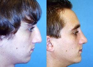 Rhinoplasty Before & After Gallery - Patient 142762998 - Image 1